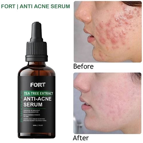 Fort Salicylic Acid Tea Tree Extract Acne Serum - Shop Online Pakistan