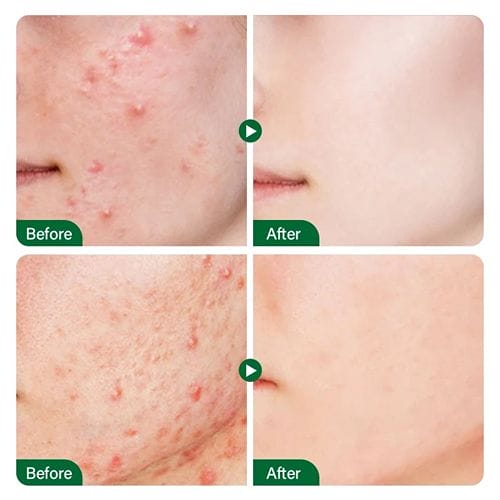 Fort Salicylic Acid Tea Tree Extract Acne Serum - Shop Online Pakistan