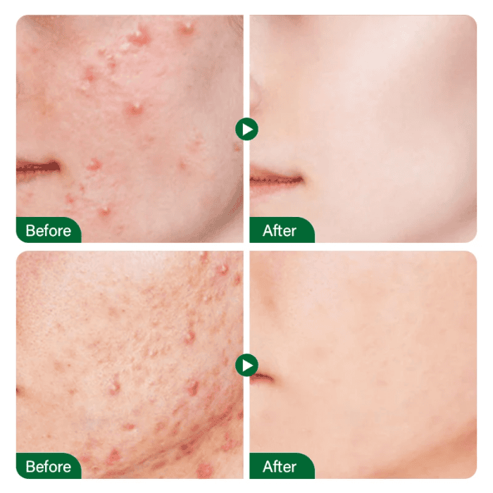 Fort Salicylic Acid Serum - Shop Online Pakistan