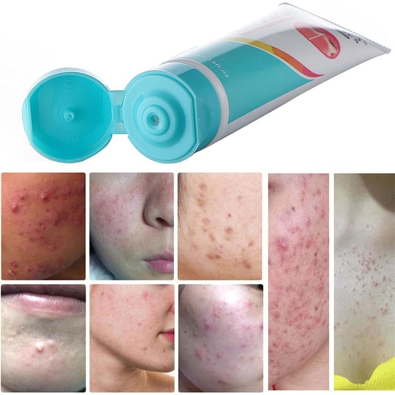 Laoshiya Acne Scar Gel - Shop Online Pakistan