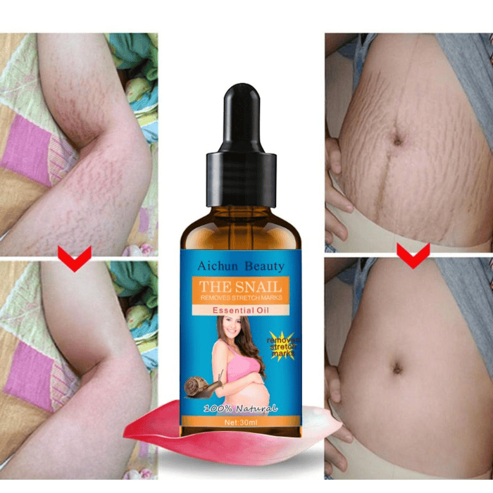 Natural Snail Extract Stretch Marks Oil - Shop Online Pakistan