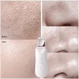 Peeling Machine Ultrasonic Facial Skin Scrubber – gallery image
