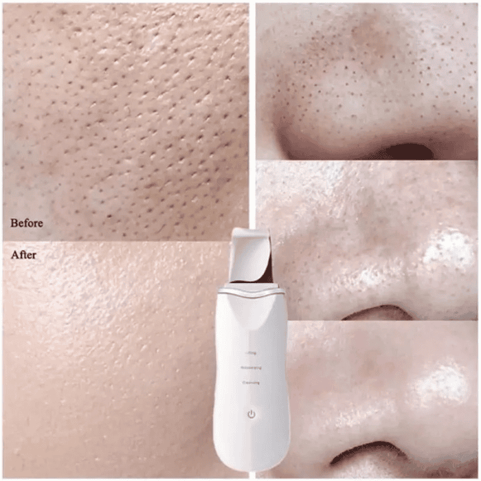 Peeling Machine Ultrasonic Facial Skin Scrubber - Shop Online Pakistan