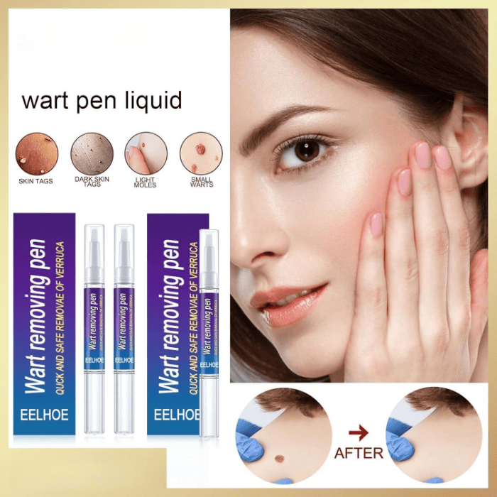 Wart Removing Pen - Shop Online Pakistan