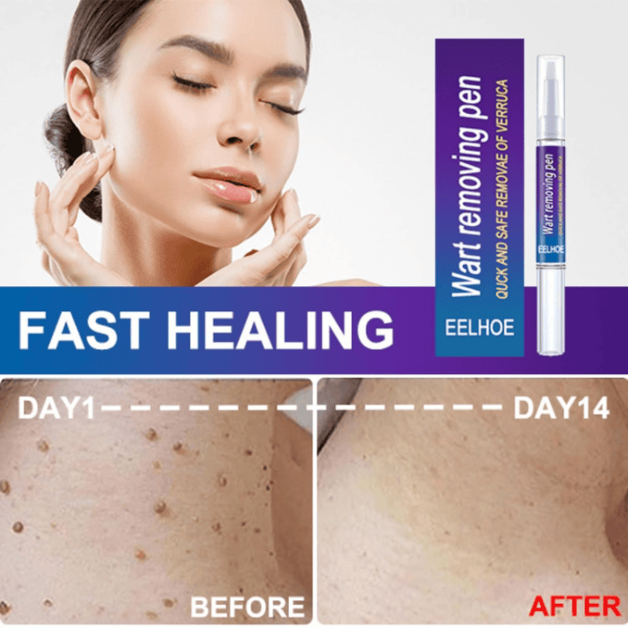 Wart Removing Pen - Shop Online Pakistan