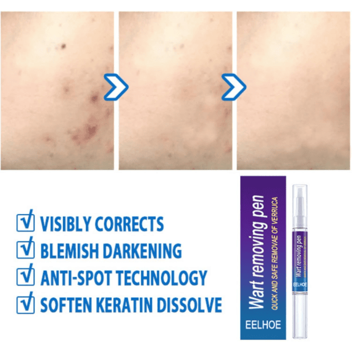 Wart Removing Pen - Shop Online Pakistan